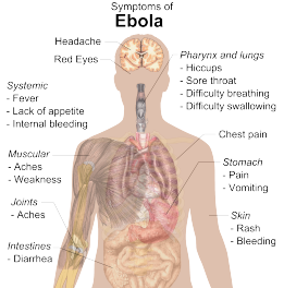 symptoms of Ebola